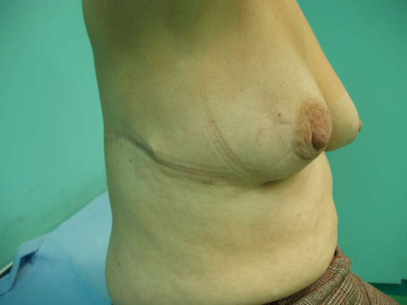 2. Reconstruction with latissimus dorsi flap